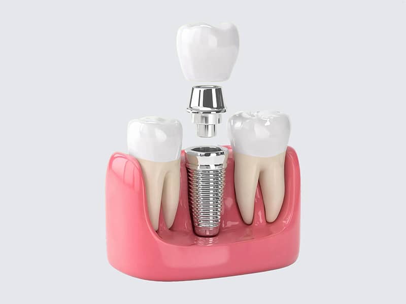Diş İmplantı