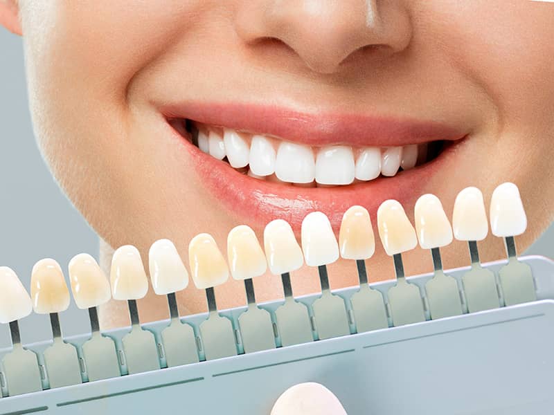 Lamine Diş (Yaprak Porselen)